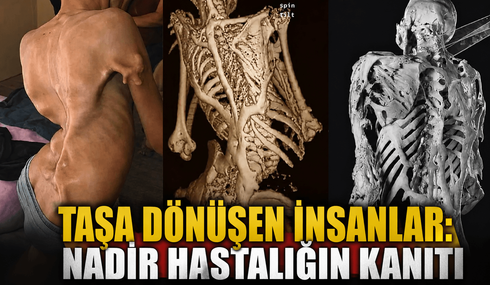 Taşa Dönüşen İnsanlar: Nadir Hastalığın Kanıtı